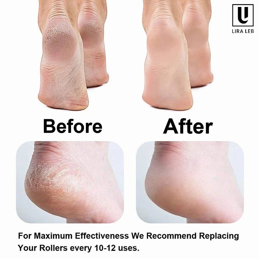 Electric Foot File, Electric Callus Remover